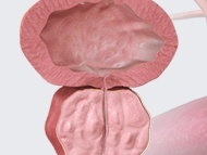 Benlgn Prostate Obstruction