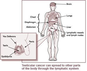 Testicular Cancer